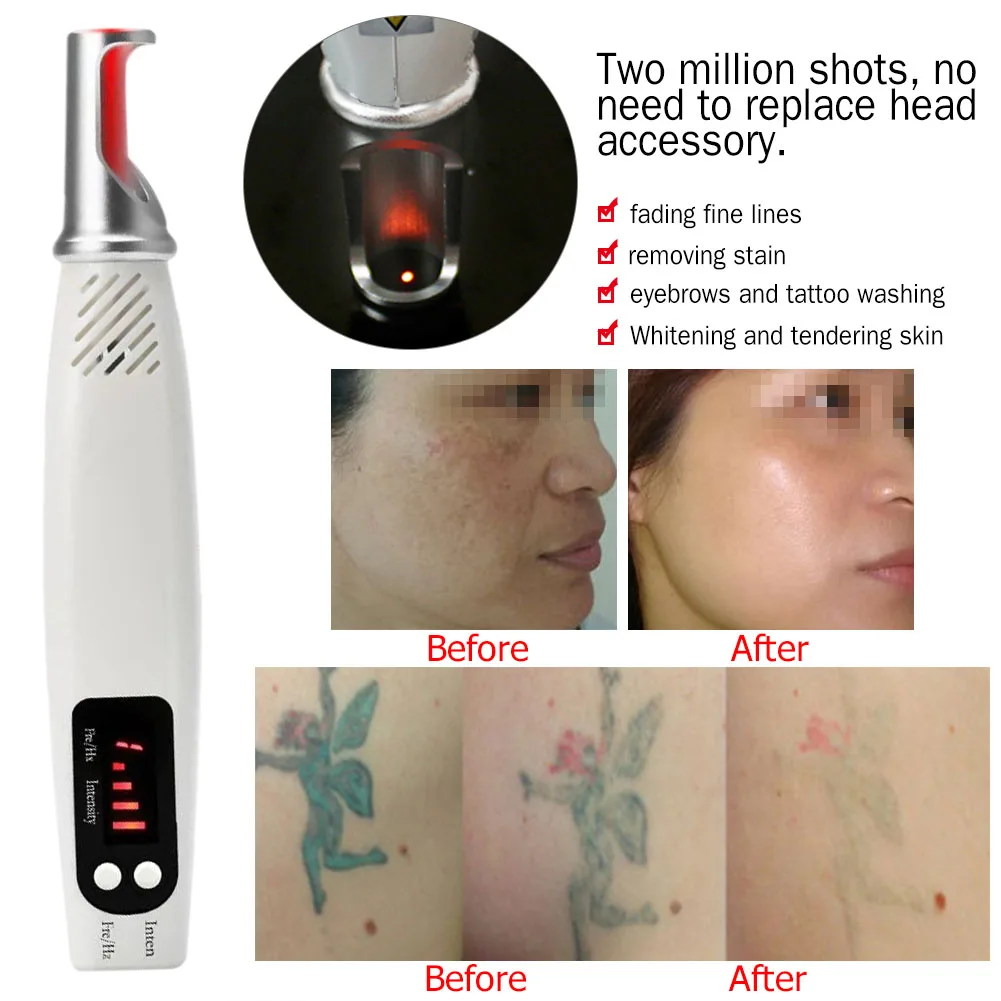 Tattoo Scar Freckle Removal Machine Adjustable Frequency Dark Spot Remover Machine Digital Display for Wart Spot Small Tattoo - Image 4